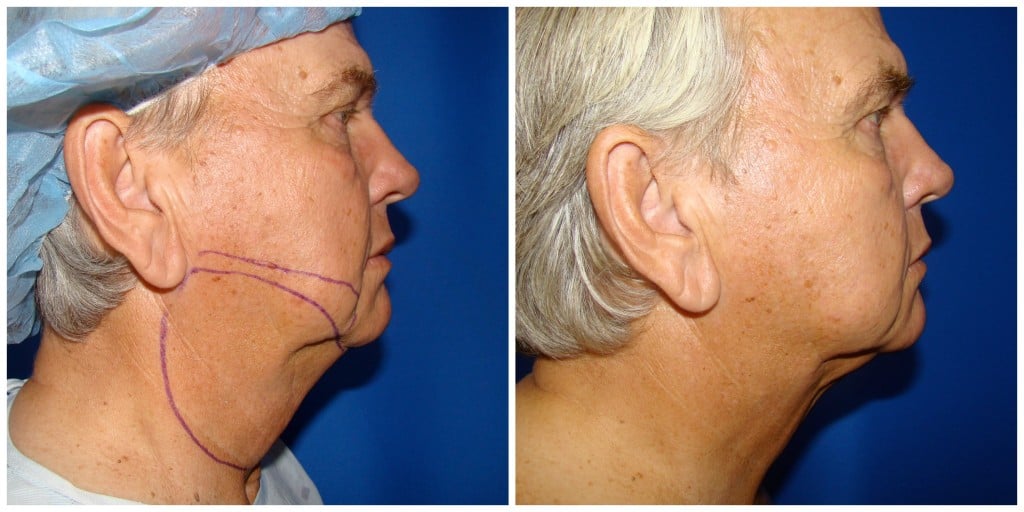 Chin Liposuction Before and After