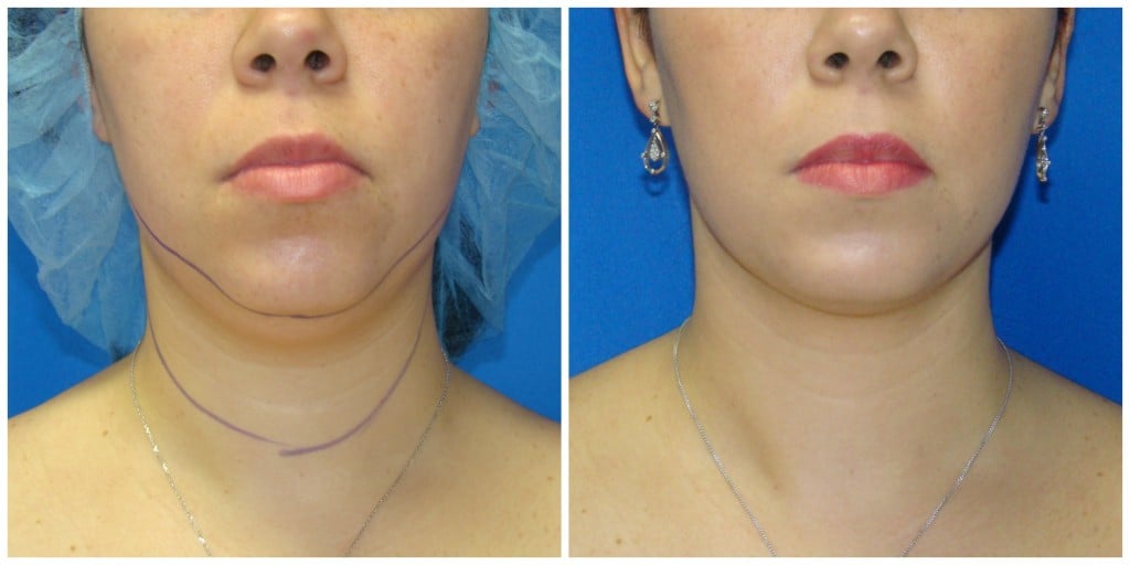 Chin Liposuction Before and After