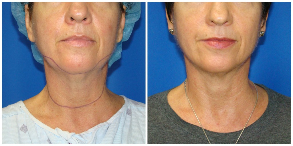 Chin Liposuction Before and After