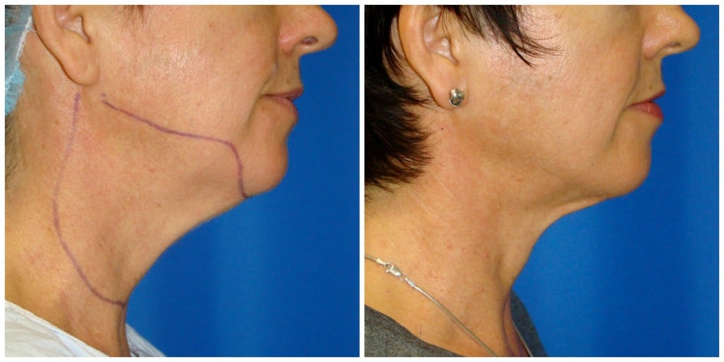 Chin Liposuction Before and After