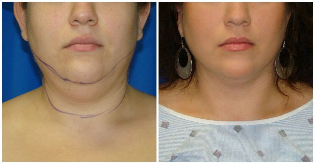 Chin Liposuction Before and After