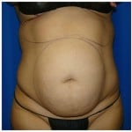 Liposuction Before & After Patient #988