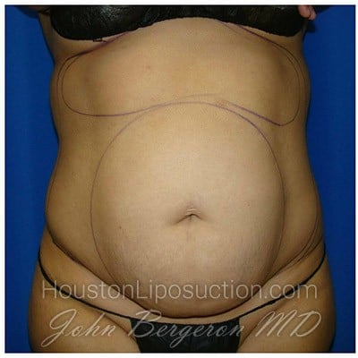 Liposuction Before & After Patient #988