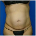 Liposuction Before & After Patient #988