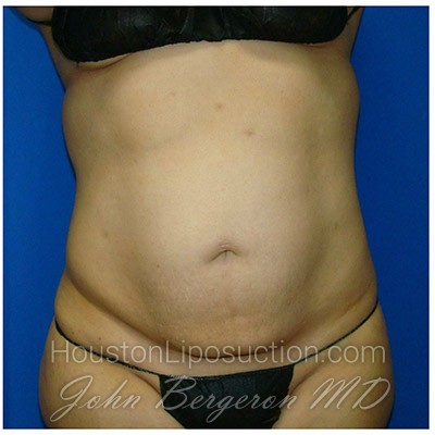 Liposuction Before & After Patient #988