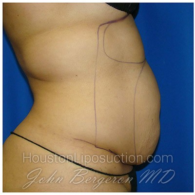 Liposuction Before & After Patient #988