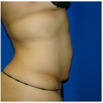 Liposuction Before & After Patient #988