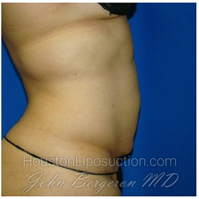 Liposuction Before & After Patient #988