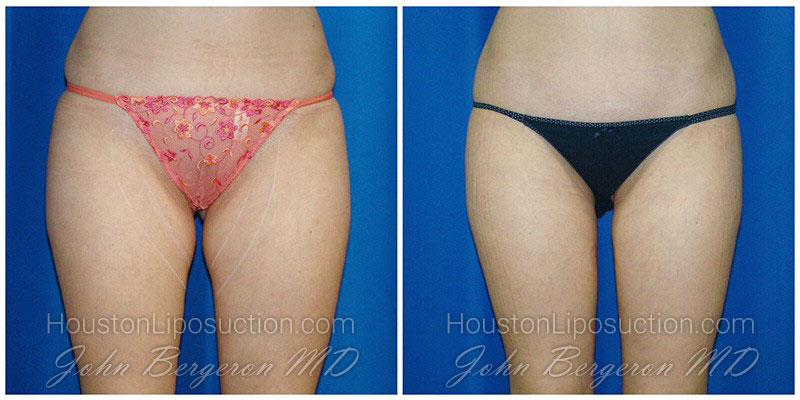 5 Things You Need to Know About Thigh Liposuction - Houston Lipo