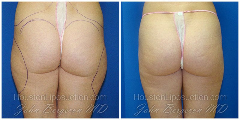 Waist & Hip Liposuction / Houston Lipo Center