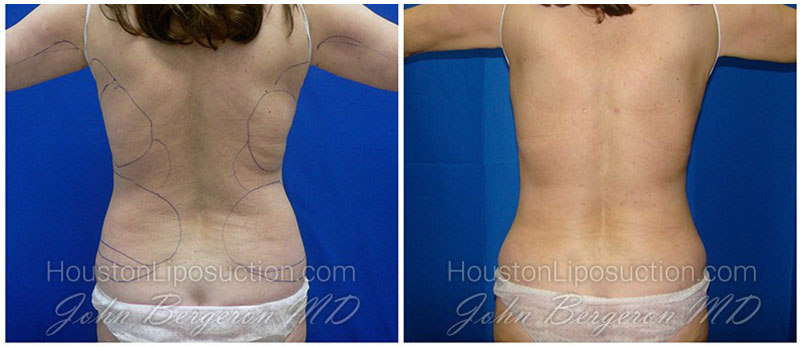 Waist & Hip Liposuction / Houston Lipo Center