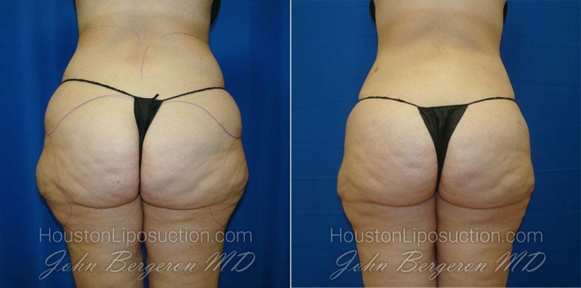 Waist & Hip Liposuction / Houston Lipo Center