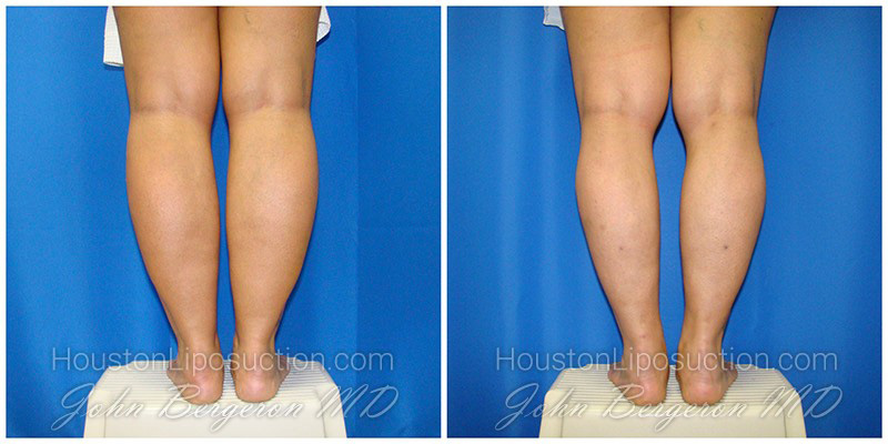 liposuction recovery liposuction recovery
