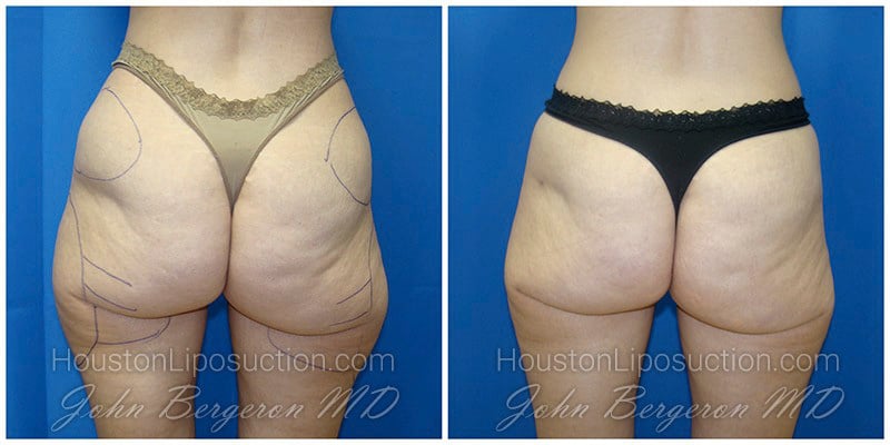 Buttocks Liposuction / Smartlipo in Houston TX