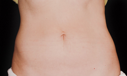 CoolSculpting Before & After Patient #1532