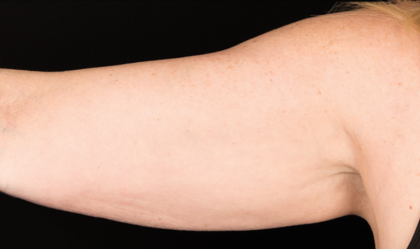 CoolSculpting Before & After Patient #1529