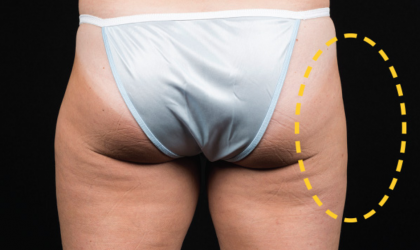 CoolSculpting Before & After Patient #1538