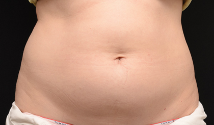 CoolSculpting Before & After Patient #1532