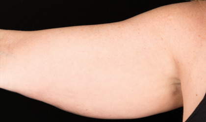 CoolSculpting Before & After Patient #1529