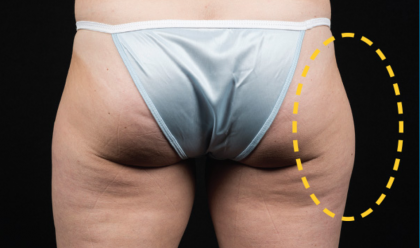 CoolSculpting Before & After Patient #1538