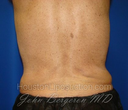 Liposuction Before & After Patient #1674