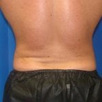 Liposuction Before & After Patient #1738