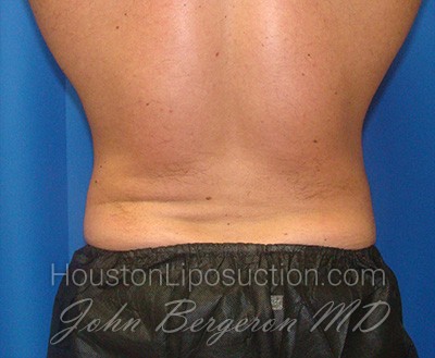 Liposuction Before & After Patient #1738