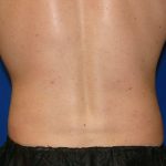 Liposuction Before & After Patient #1745