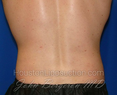 Liposuction Before & After Patient #1745