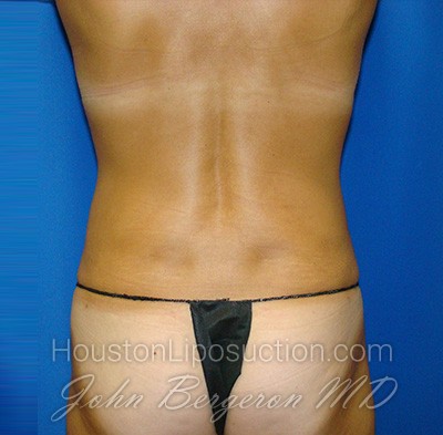 Liposuction Before & After Patient #1690