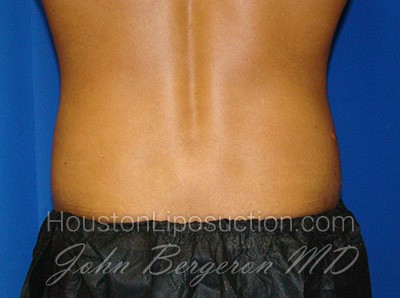 Liposuction Before & After Patient #1700