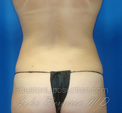 Liposuction Before & After Patient #1714