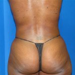 Liposuction Before & After Patient #1723