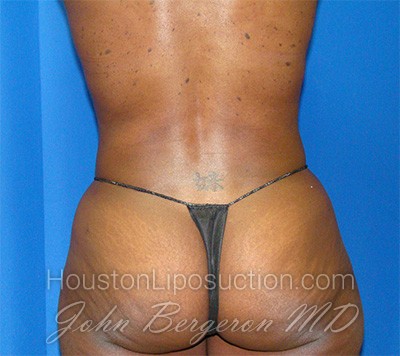 Liposuction Before & After Patient #1723