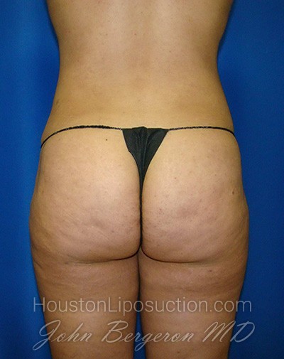 Liposuction Before & After Patient #1735