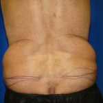 Liposuction Before & After Patient #1674