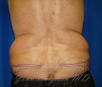 Liposuction Before & After Patient #1674