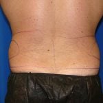 Liposuction Before & After Patient #1738