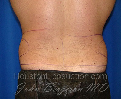 Liposuction Before & After Patient #1738