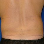 Liposuction Before & After Patient #1745