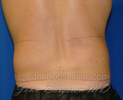 Liposuction Before & After Patient #1745