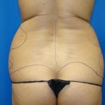 Liposuction Before & After Patient #1752