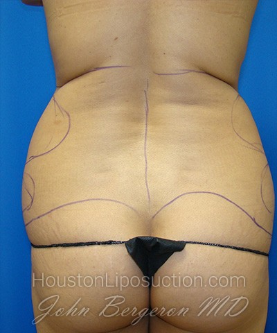 Liposuction Before & After Patient #1752