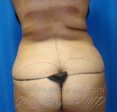 Liposuction Before & After Patient #1677