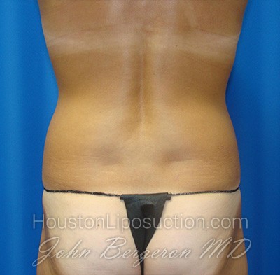 Liposuction Before & After Patient #1690