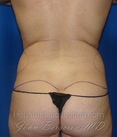 Liposuction Before & After Patient #1697