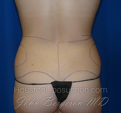 Liposuction Before & After Patient #1714