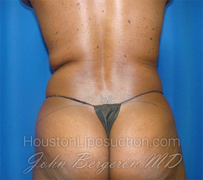 Liposuction Before & After Patient #1723