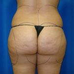 Liposuction Before & After Patient #1735