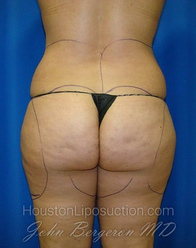 Liposuction Before & After Patient #1735